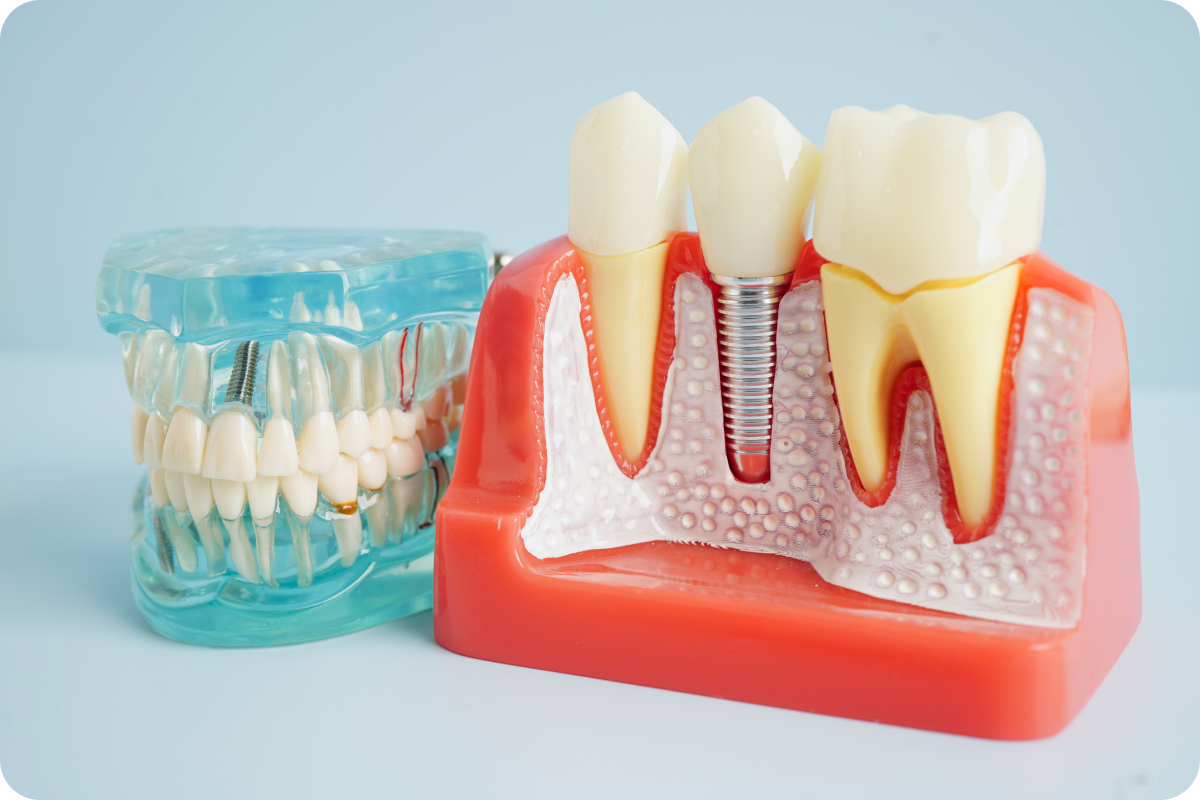 Implant dentaire posé dans l'os de la mâchoire à Rambouillet