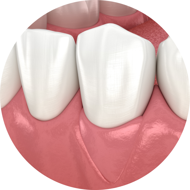 Greffe de gencive et chirurgie muco-gingivale à Rambouillet