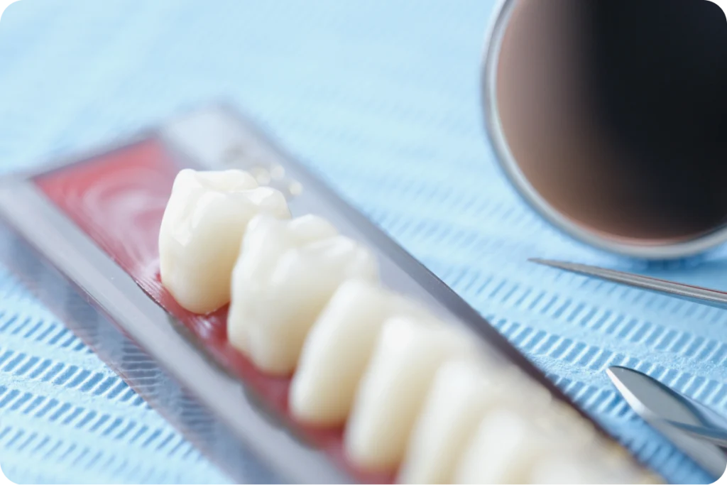 Couronne sur implant après implantation immédiate à Rambouillet