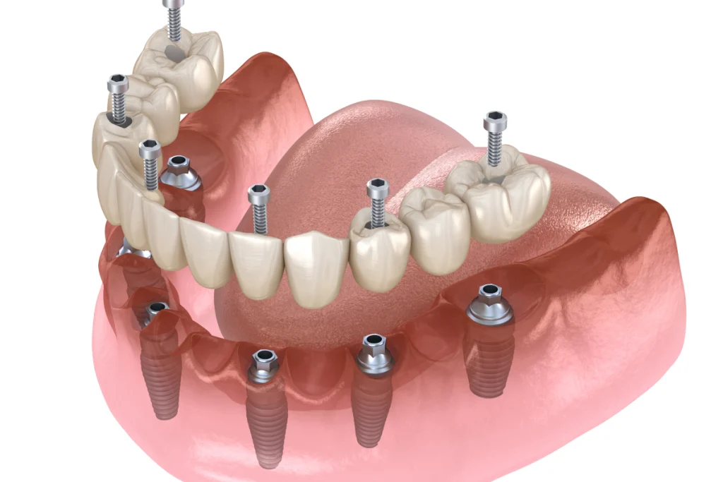 Réhabilitation complète sur implants à Rambouillet